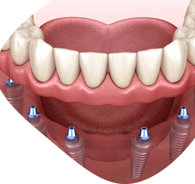 DentalCross - All-on-6: Sigurno i trajno rešenje za vaš osmeh
